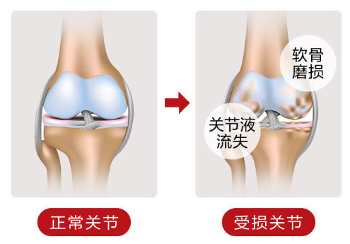 关节疼痛吃氨糖软骨素有效果吗？ 