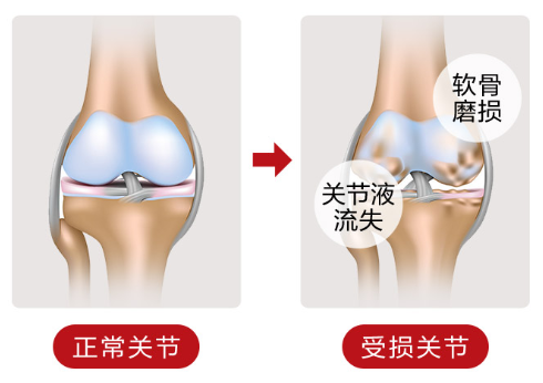 关节炎怎么治疗更好最有效呢？强烈推荐这个氨糖 