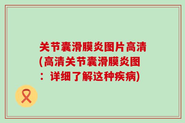关节囊滑膜炎图片高清(高清关节囊滑膜炎图：详细了解这种疾病)