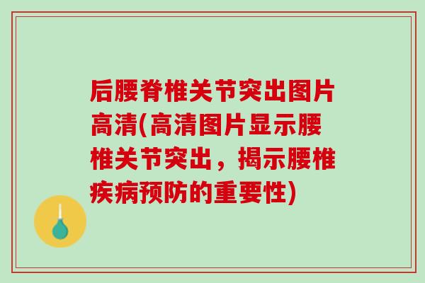 后腰脊椎关节突出图片高清(高清图片显示腰椎关节突出，揭示腰椎疾病预防的重要性)