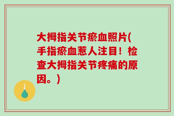 大拇指关节瘀血照片(手指瘀血惹人注目！检查大拇指关节疼痛的原因。)