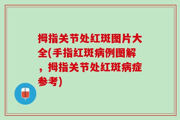 拇指关节处红斑图片大全(手指红斑病例图解，拇指关节处红斑病症参考)