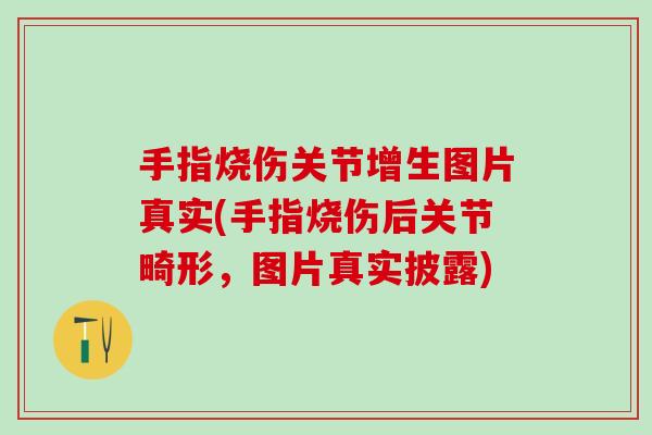 手指烧伤关节增生图片真实(手指烧伤后关节畸形，图片真实披露)