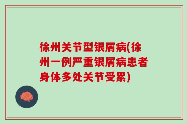 徐州关节型银屑病(徐州一例严重银屑病患者身体多处关节受累)