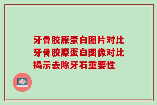 牙骨胶原蛋白图片对比牙骨胶原蛋白图像对比揭示去除牙石重要性